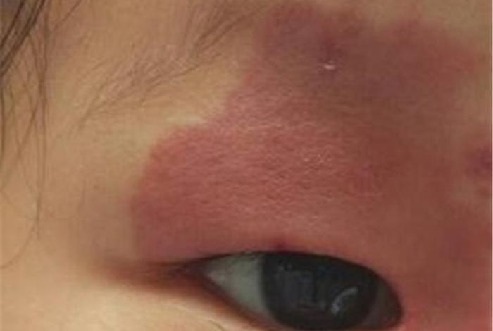 胎记真的消失不见吗 - 胎记不会消失吗