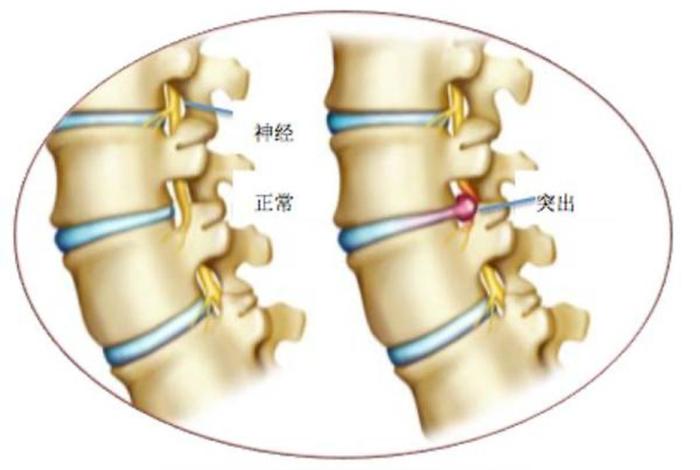 佛教腰椎间盘突出是什么果报、佛教讲腰椎间盘突出的因