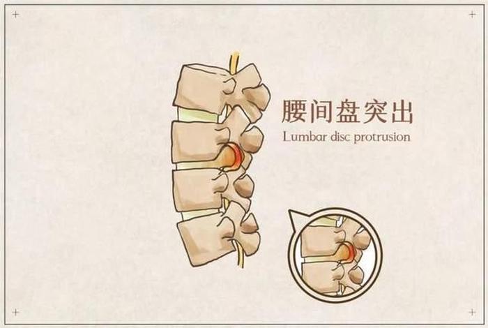 佛教腰椎间盘突出是什么果报、佛教讲腰椎间盘突出的因
