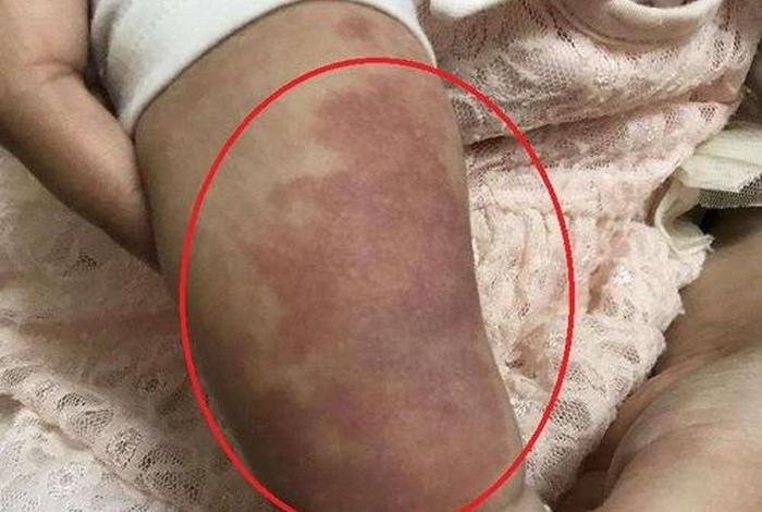 胎记突然消失 胎记突然消失了预示什么