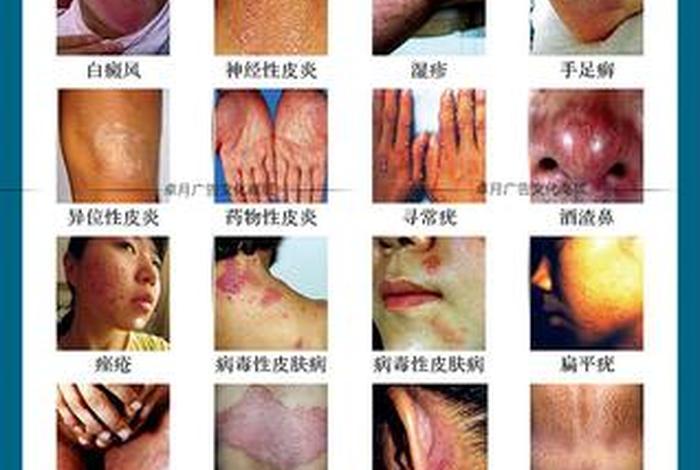史上最全的皮肤病图谱 - 皮肤病图谱大全(珍藏版)共1000多张