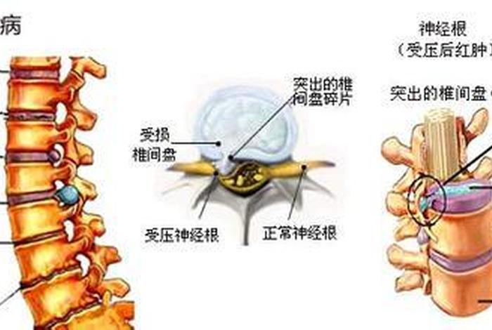 佛教讲腰椎间盘突出因果；佛教讲腰椎间盘突出的因