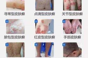 史上最全的皮肤病图谱 - 皮肤病图谱大全(珍藏版)共1000多张
