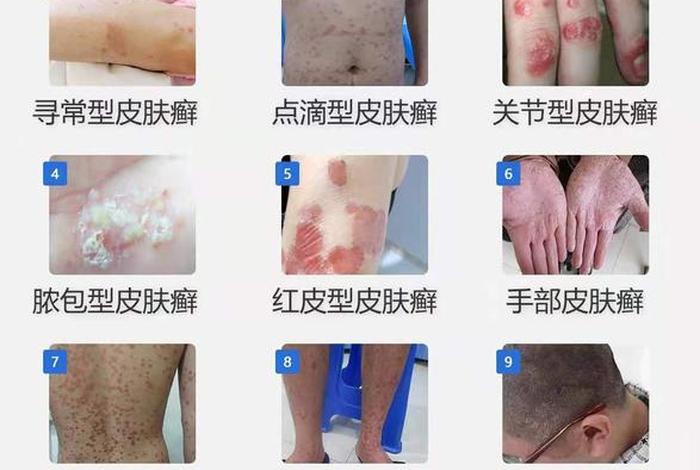 史上最全的皮肤病图谱 - 皮肤病图谱大全(珍藏版)共1000多张