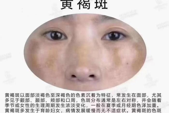 脸上长斑前世因果；脸上长斑是业障吗？