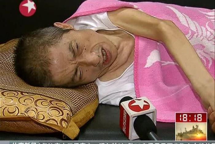 渐冻人是什么意思啊；渐冻人症是什么症状